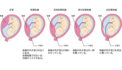 胎盤形成出血|胎盤の重要な役割と前置胎盤などのトラブル